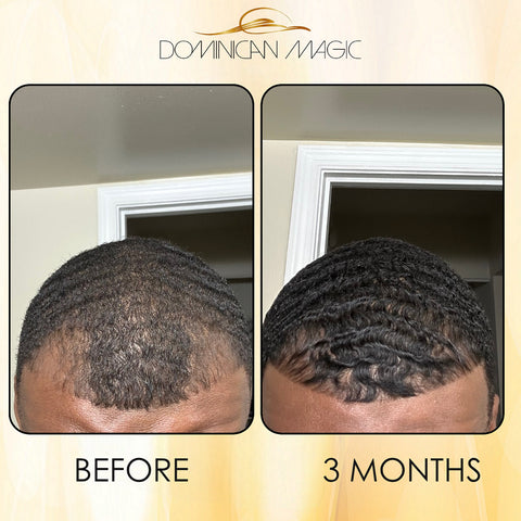 Dominican Magic Hair Follicle Anti-Aging Scalp Drop Hair Tonic with Rosemary and Cinnamon, Gotero Anti-Caida, Helps Stimulate Hair Growth - Dominican magic